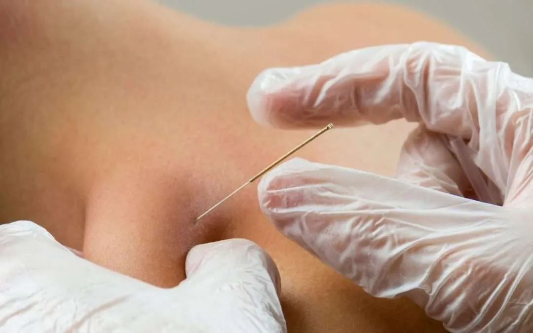 What is Dry Needling?